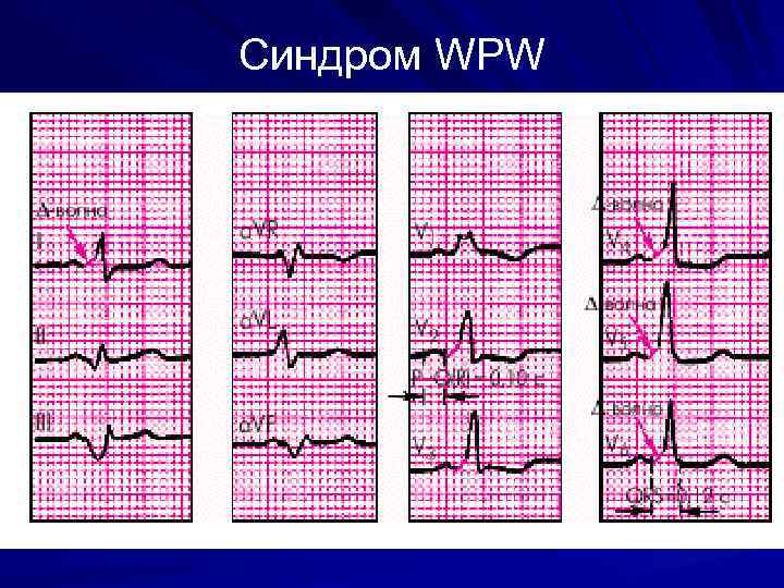 Wpw синдром на экг фото