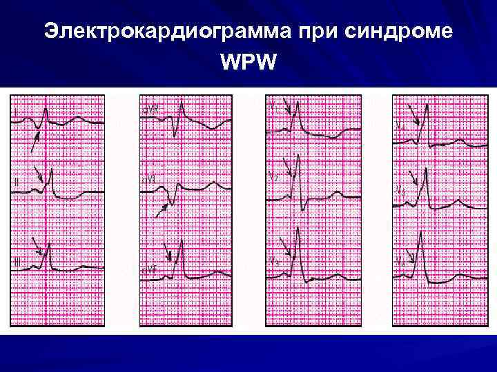 Wpw синдром на экг картинки