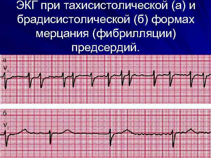 Карта вызова смп фибрилляция предсердий тахисистолическая форма