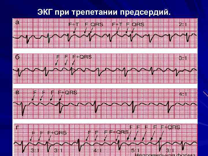 ЭКГ при трепетании предсердий. 