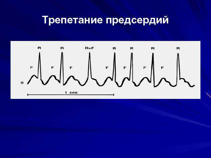 Трепетание предсердий 