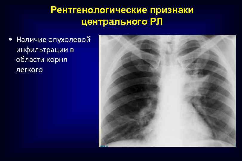 Рентгенологические признаки центрального РЛ • Наличие опухолевой инфильтрации в области корня легкого 