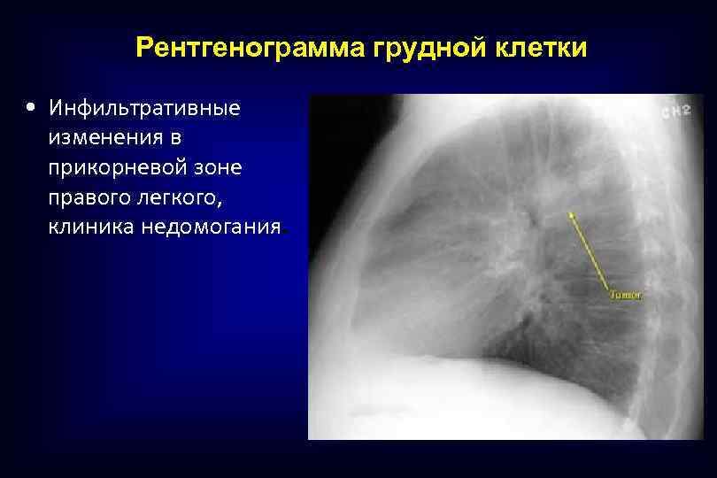 Рентгенограмма грудной клетки • Инфильтративные изменения в прикорневой зоне правого легкого, клиника недомогания. 