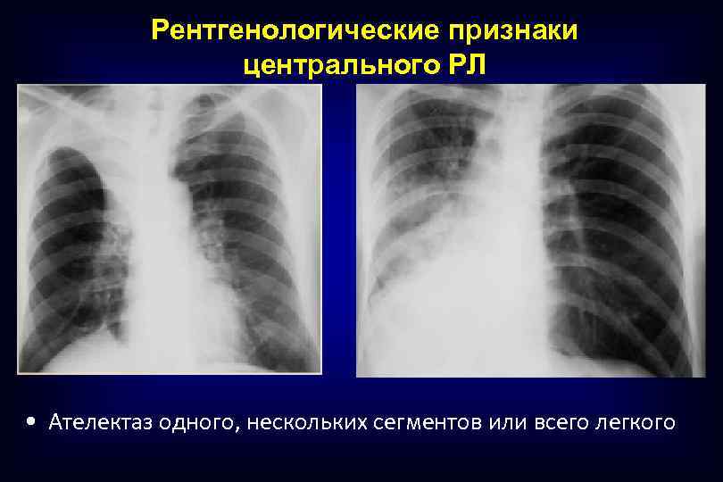 Рентгенологические признаки центрального РЛ • Ателектаз одного, нескольких сегментов или всего легкого 