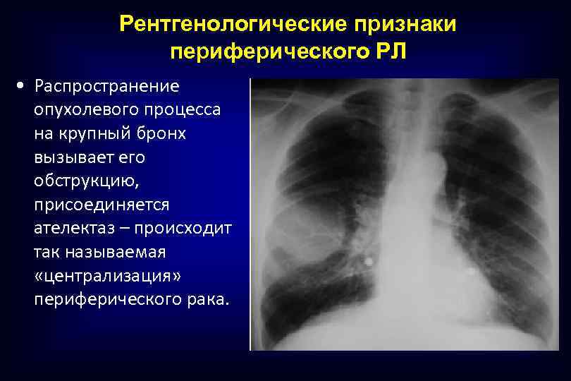 Рентгенологические признаки периферического РЛ • Распространение опухолевого процесса на крупный бронх вызывает его обструкцию,