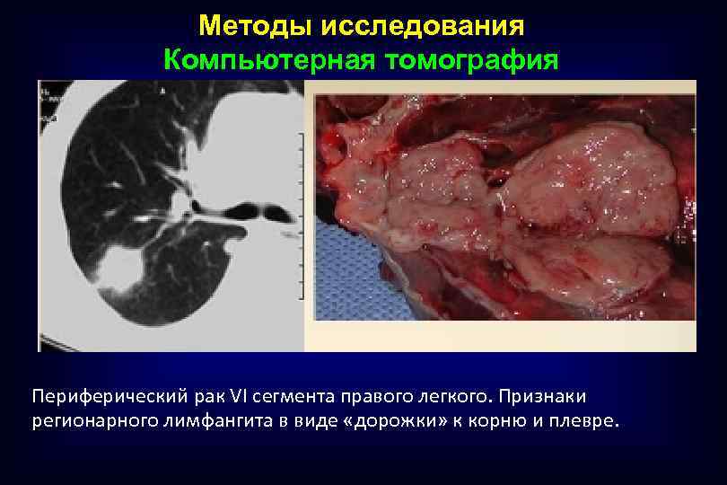 Методы исследования Компьютерная томография Периферический рак VI сегмента правого легкого. Признаки регионарного лимфангита в