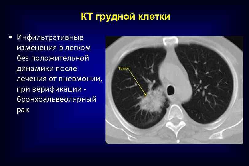 КТ грудной клетки • Инфильтративные изменения в легком без положительной динамики после лечения от