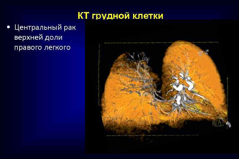 КТ грудной клетки • Центральный рак верхней доли правого легкого 