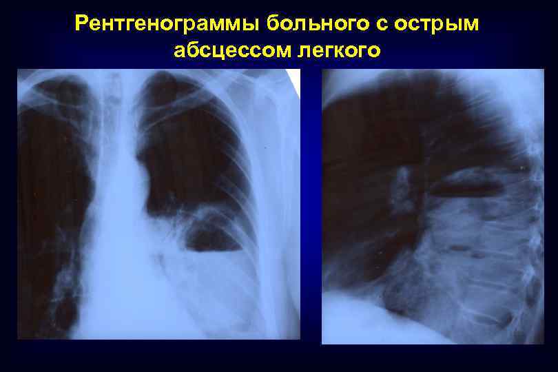 Рентгенограммы больного с острым абсцессом легкого 