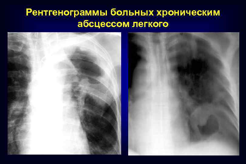 Рентгенограммы больных хроническим абсцессом легкого 