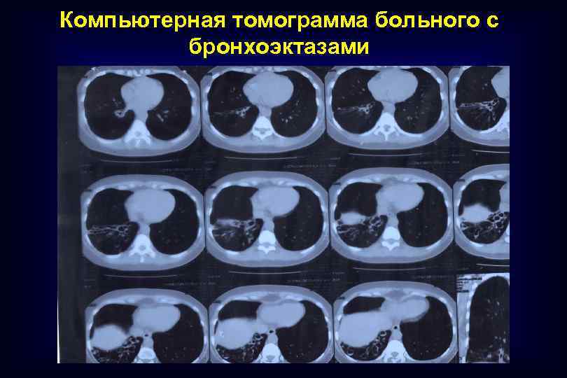 Компьютерная томограмма больного с бронхоэктазами 