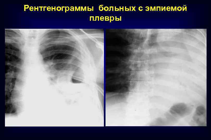 Рентгенограммы больных с эмпиемой плевры 