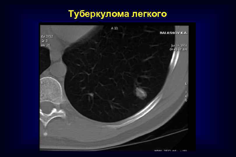 Туберкулома легких картинки