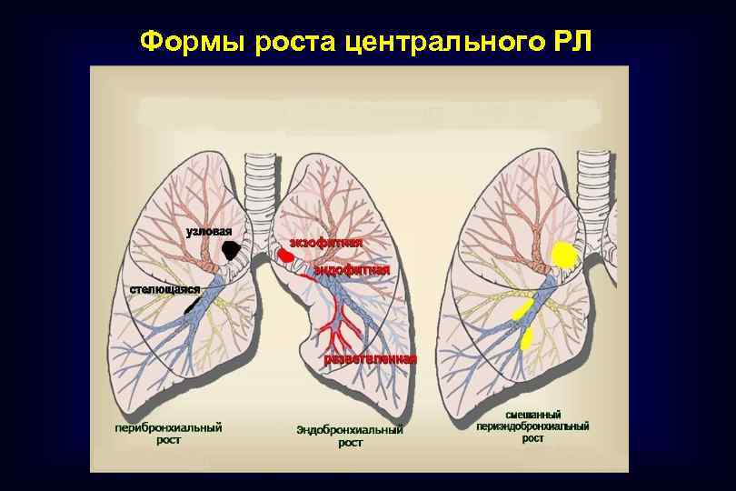 Формы роста центрального РЛ 