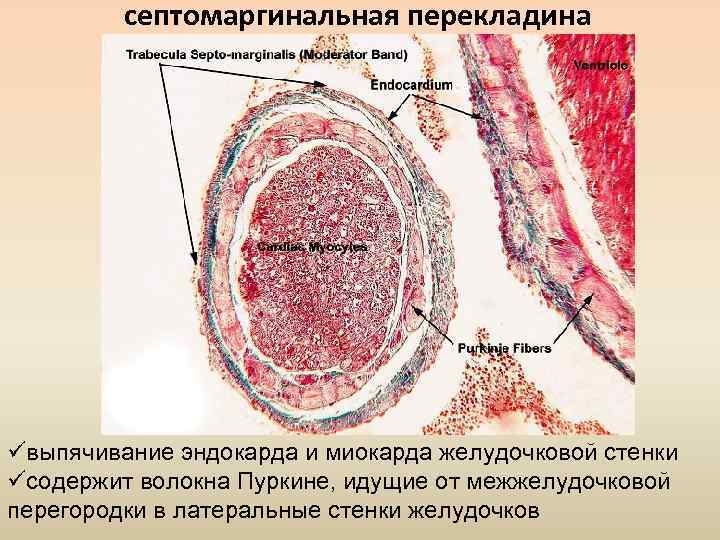 септомаргинальная перекладина üвыпячивание эндокарда и миокарда желудочковой стенки üсодержит волокна Пуркине, идущие от межжелудочковой