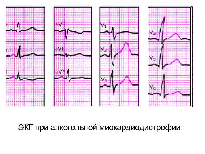 ЭКГ при алкогольной миокардиодистрофии 