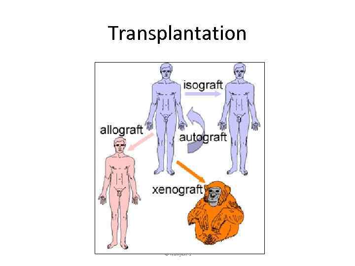 Transplantation © Ranjith’s 