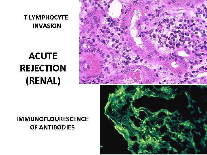 T LYMPHOCYTE INVASION ACUTE REJECTION (RENAL) IMMUNOFLOURESCENCE OF ANTIBODIES 