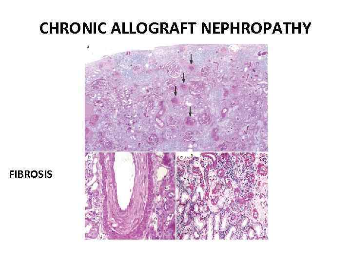 CHRONIC ALLOGRAFT NEPHROPATHY FIBROSIS 