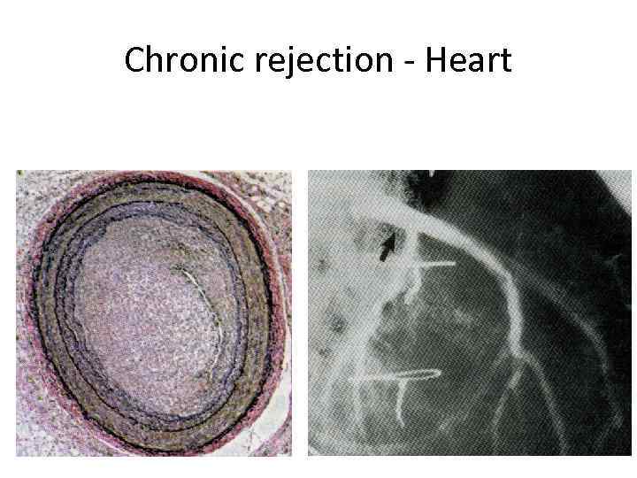 Chronic rejection - Heart 