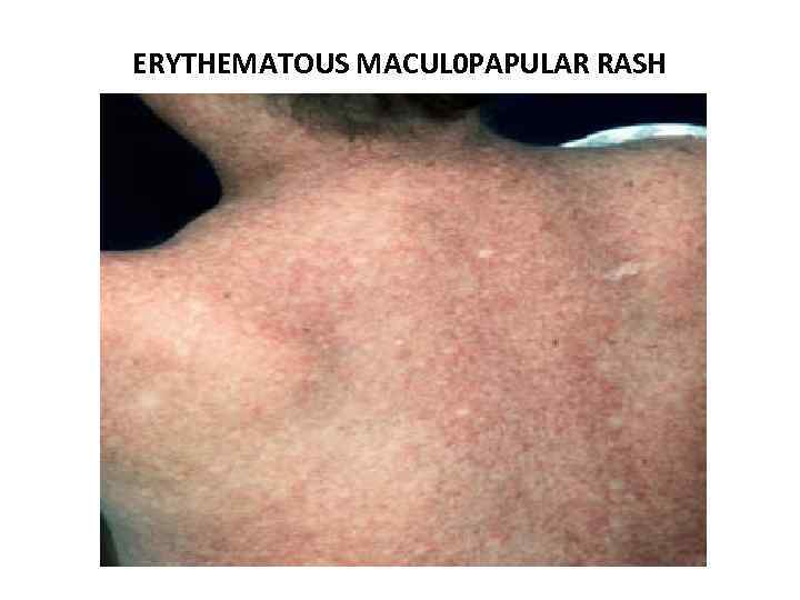 ERYTHEMATOUS MACUL 0 PAPULAR RASH 