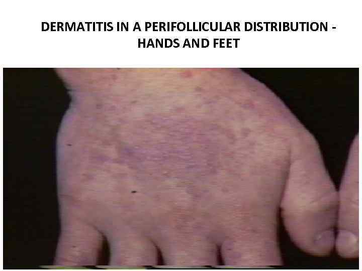 DERMATITIS IN A PERIFOLLICULAR DISTRIBUTION HANDS AND FEET 