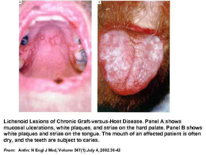 Lichenoid Lesions of Chronic Graft-versus-Host Disease. Panel A shows mucosal ulcerations, white plaques, and