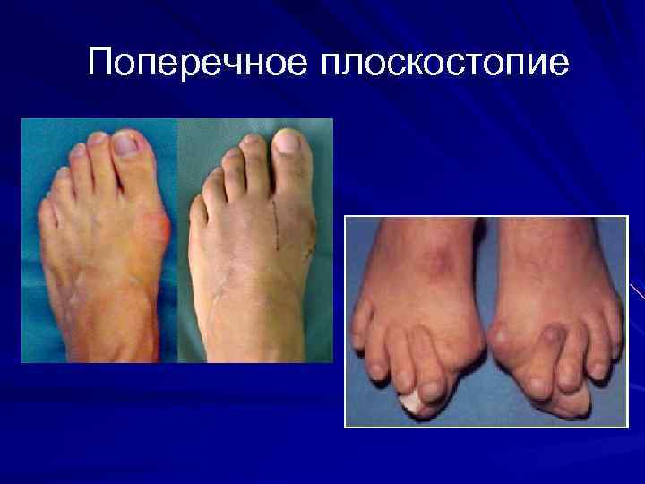 Поперечное плоскостопие 