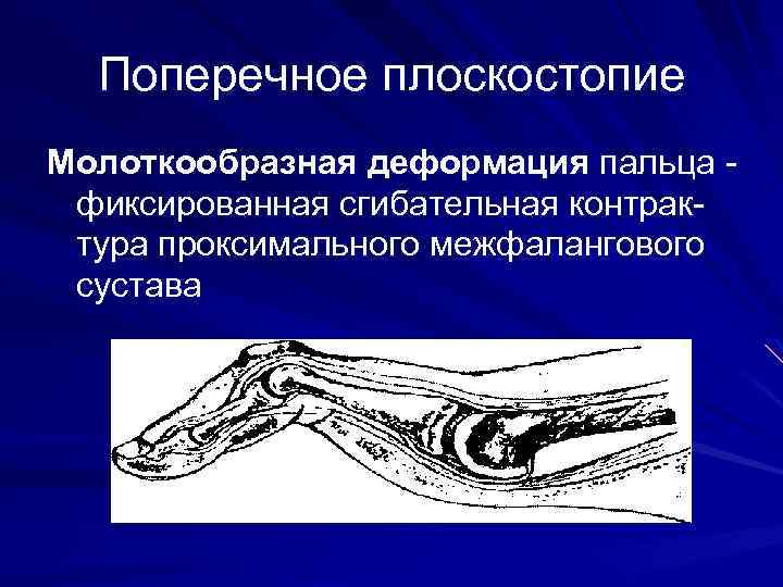 Поперечное плоскостопие Молоткообразная деформация пальца фиксированная сгибательная контрактура проксимального межфалангового сустава 