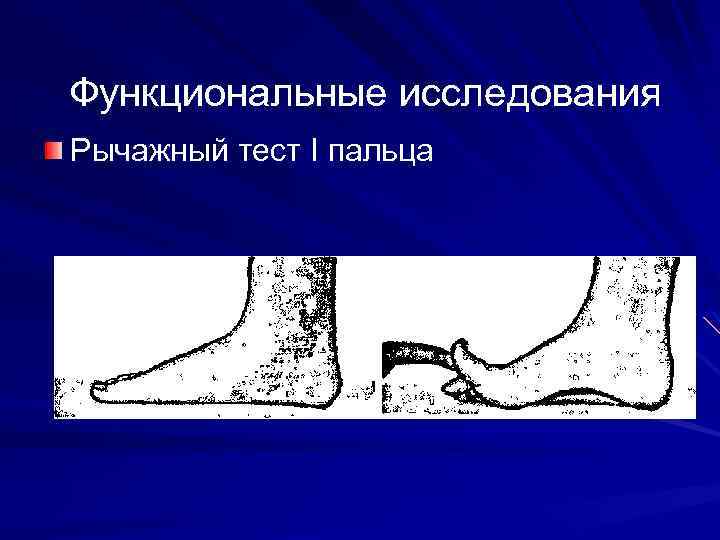 Функциональные исследования Рычажный тест I пальца 