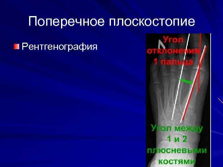 Поперечное плоскостопие Рентгенография 