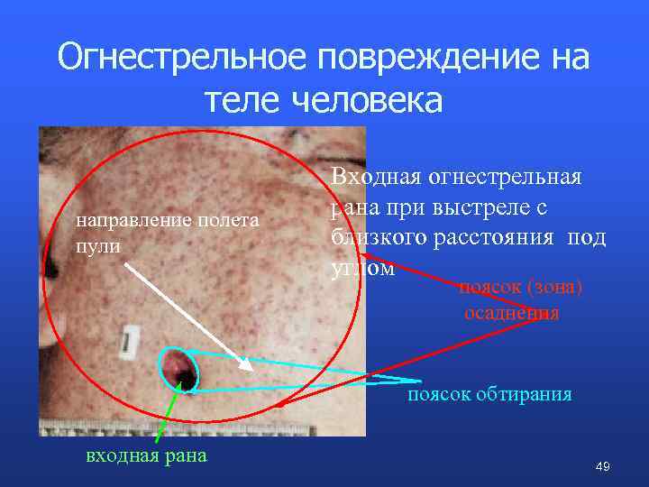 Огнестрельное повреждение на теле человека направление полета пули Входная огнестрельная рана при выстреле с