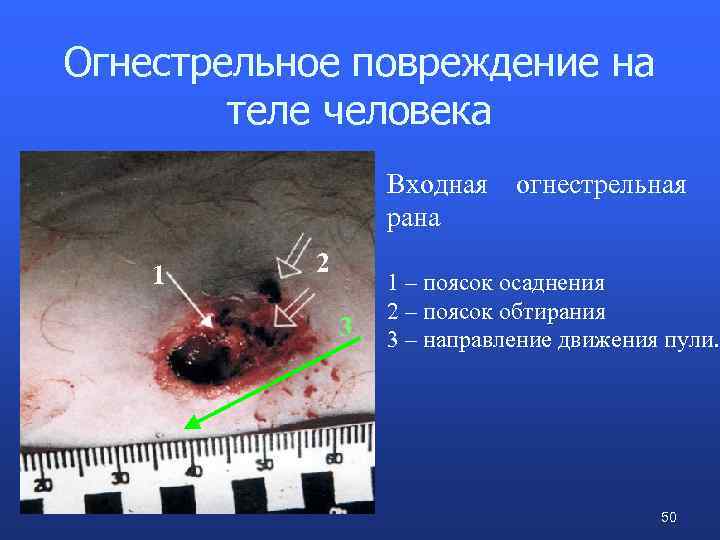 Огнестрельное повреждение на теле человека Входная рана 1 2 3 огнестрельная 1 – поясок