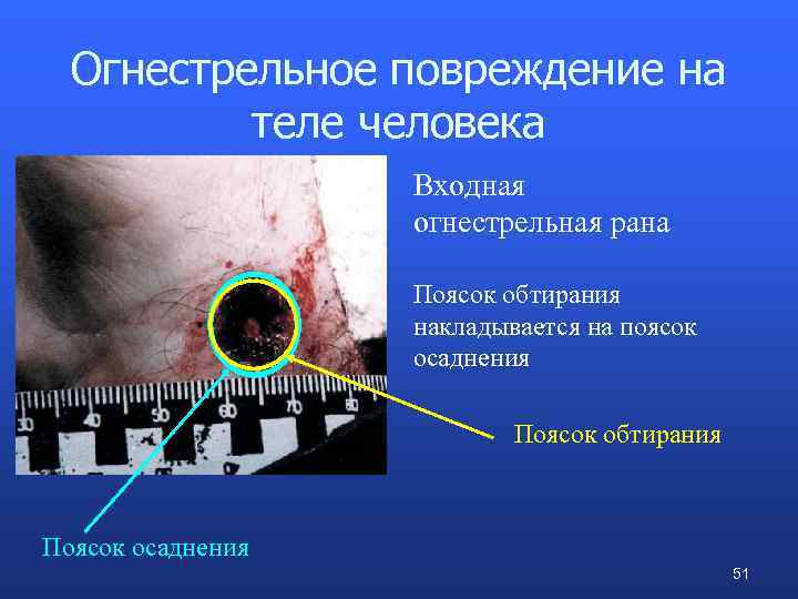 Огнестрельное повреждение на теле человека Входная огнестрельная рана Поясок обтирания накладывается на поясок осаднения