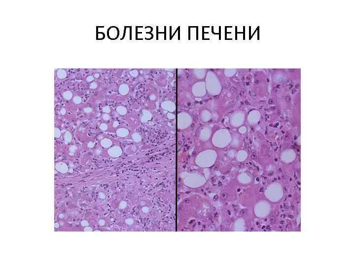 БОЛЕЗНИ ПЕЧЕНИ 