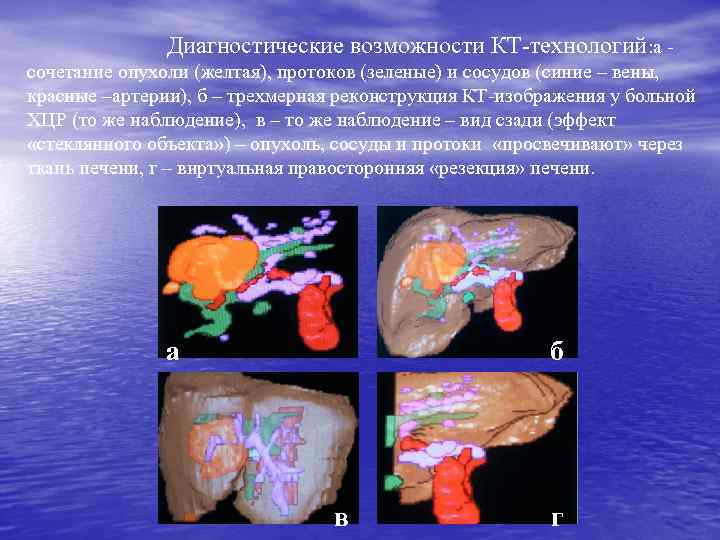 Диагностические возможности КТ-технологий: а сочетание опухоли (желтая), протоков (зеленые) и сосудов (синие – вены,