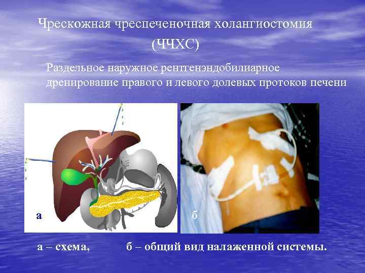 Чрескожная чреспеченочная холангиостомия (ЧЧХС) Раздельное наружное рентгенэндобилиарное дренирование правого и левого долевых протоков печени