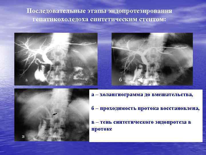 Последовательные этапы эндопротезирования гепатикохоледоха синтетическим стентом: а б а – холангиограмма до вмешательства, б