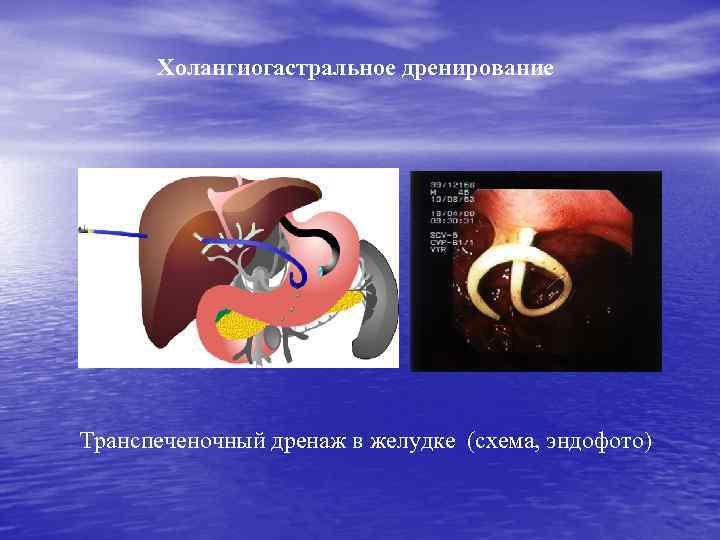Холангиогастральное дренирование Транспеченочный дренаж в желудке (схема, эндофото) 