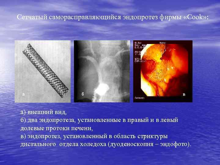 Сетчатый саморасправляющийся эндопротез фирмы «Cook» : а б в а) внешний вид, б) два