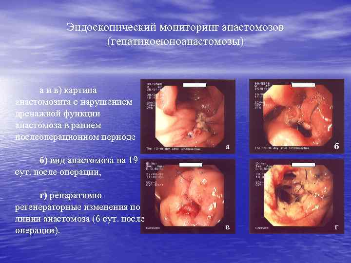 Эндоскопический мониторинг анастомозов (гепатикоеюноанастомозы) а и в) картина анастомозита с нарушением дренажной функции анастомоза