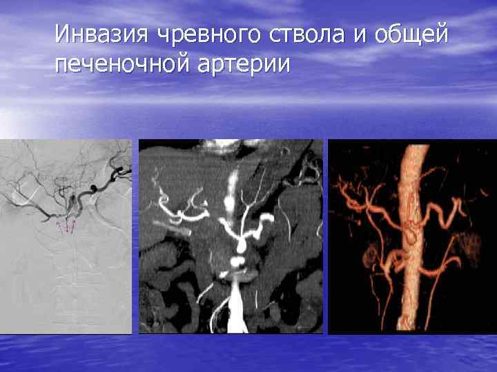 Инвазия чревного ствола и общей печеночной артерии 