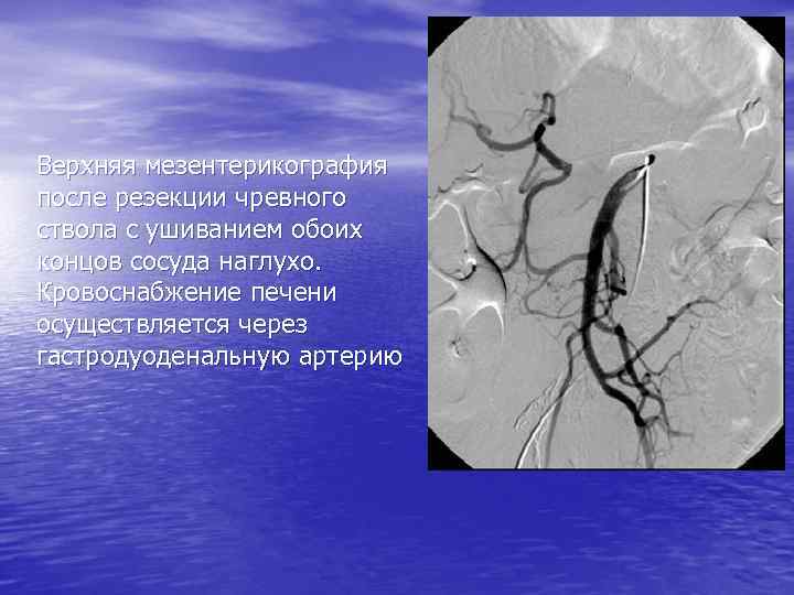 Верхняя мезентерикография после резекции чревного ствола с ушиванием обоих концов сосуда наглухо. Кровоснабжение печени