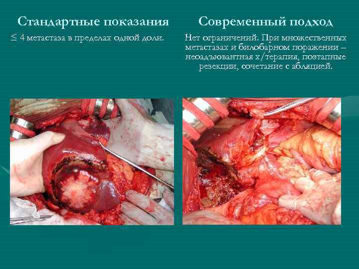 Стандартные показания ≤ 4 метастаза в пределах одной доли. Современный подход Нет ограничений. При