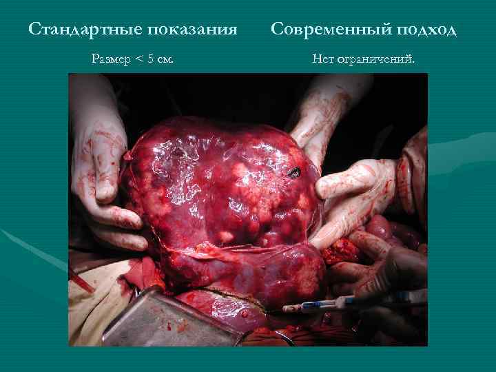 Стандартные показания Современный подход Размер < 5 см. Нет ограничений. 