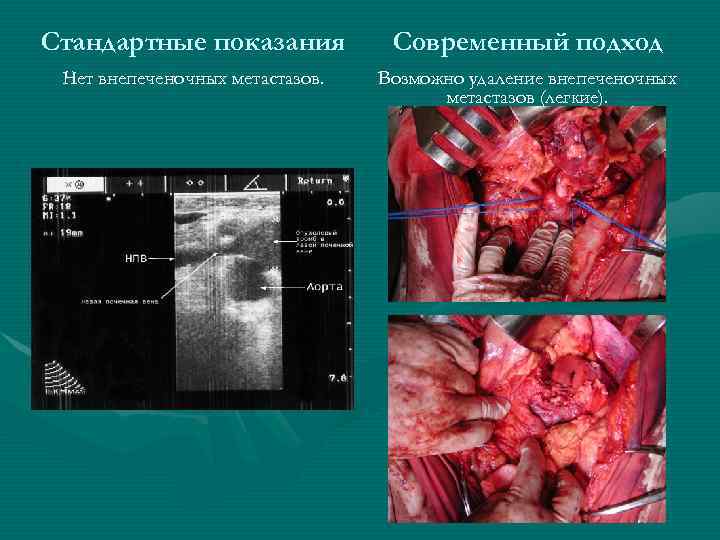 Стандартные показания Современный подход Нет внепеченочных метастазов. Возможно удаление внепеченочных метастазов (легкие). 