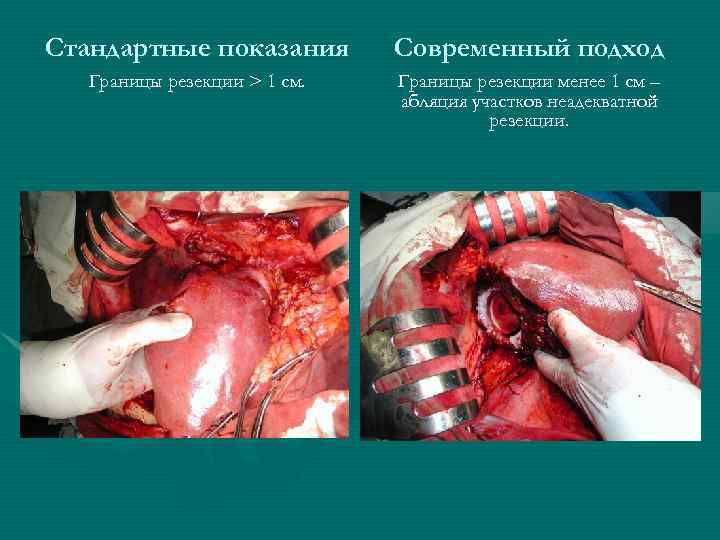 Стандартные показания Современный подход Границы резекции > 1 см. Границы резекции менее 1 см
