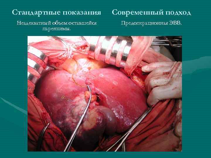 Стандартные показания Современный подход Неадекватный объем оставшейся паренхимы. Предоперационная ЭВВ. 