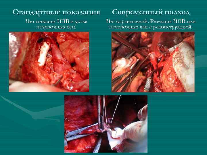 Стандартные показания Современный подход Нет инвазии НПВ и устья печеночных вен. Нет ограничений. Резекция