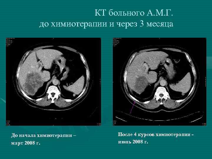 КТ больного А. М. Г. до химиотерапии и через 3 месяца До начала химиотерапии